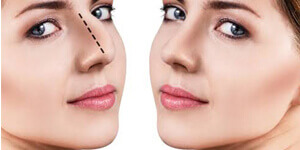 nose-reshaping-home-img